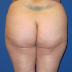 Fat Transfer to the Butt/Brazilian Butt Lift (BBL)