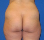 Fat Transfer to the Butt/Brazilian Butt Lift (BBL)