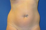 Liposuction