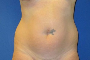 Liposuction