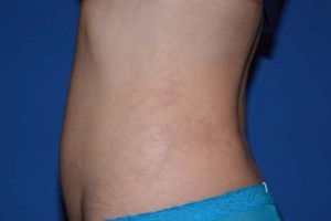 Liposuction