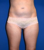 Liposuction