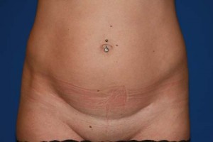 Tummy Tuck