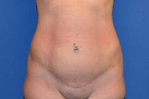 Tummy Tuck