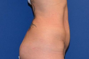 Tummy Tuck