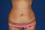 Tummy Tuck