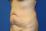 Tummy Tuck