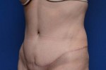 Tummy Tuck