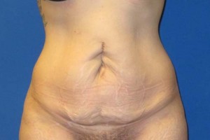 Tummy Tuck