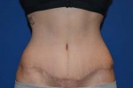 Tummy Tuck