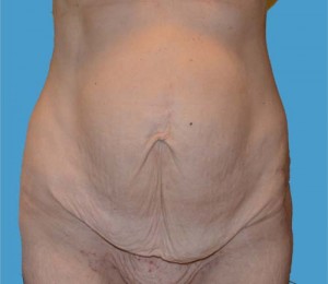 Tummy Tuck