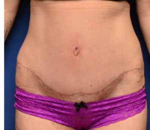 Tummy Tuck