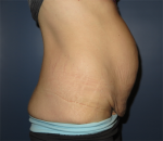 Tummy Tuck