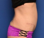 Tummy Tuck