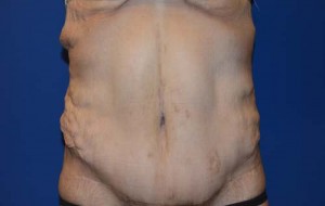 Tummy Tuck After Large Weight Loss