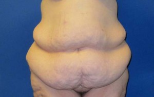 Tummy Tuck After Large Weight Loss