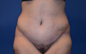 Tummy Tuck After Large Weight Loss