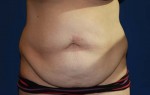 Tummy Tuck After Large Weight Loss