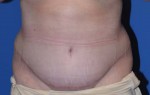 Tummy Tuck After Large Weight Loss