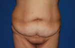 Tummy Tuck After Large Weight Loss