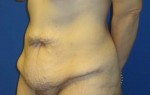 Tummy Tuck After Large Weight Loss