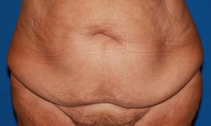 Tummy Tuck After Large Weight Loss