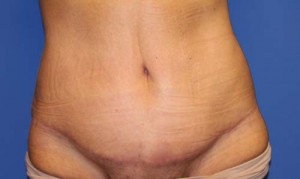 Tummy Tuck After Large Weight Loss