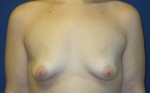 Breast Augmentation