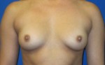 Breast Augmentation