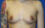 Breast Augmentation