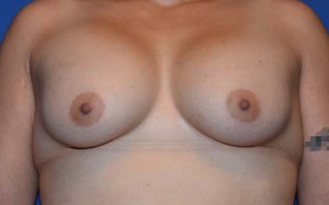 Breast Augmentation