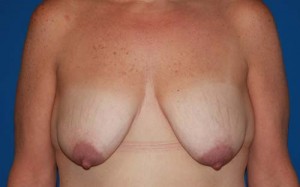 Breast Lift & Augmentation