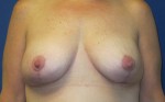 Breast Lift & Augmentation