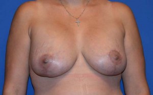 Breast Lift & Augmentation
