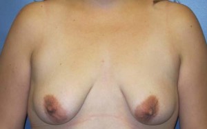 Breast Lift & Augmentation