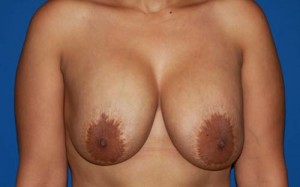 Cosmetic Breast Revision