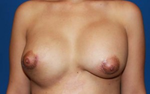 Cosmetic Breast Revision