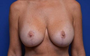 Cosmetic Breast Revision