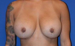 Cosmetic Breast Revision