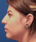 Rhinoplasty