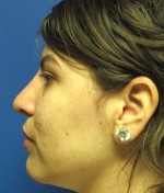 Rhinoplasty