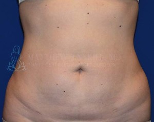 Liposuction