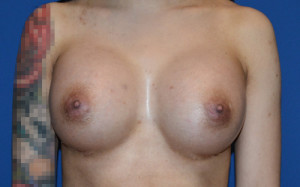 Breast Augmentation