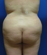 Fat Transfer to the Butt/Brazilian Butt Lift (BBL)