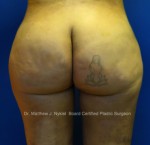 Fat Transfer to the Butt/Brazilian Butt Lift (BBL)