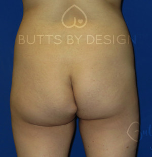 Fat Transfer to the Butt/Brazilian Butt Lift (BBL)