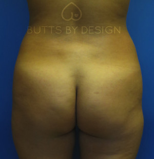 Fat Transfer to the Butt/Brazilian Butt Lift (BBL)