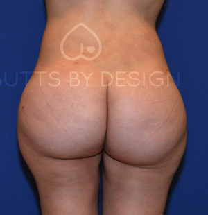 Fat Transfer to the Butt/Brazilian Butt Lift (BBL)