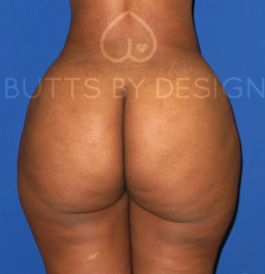 Fat Transfer to the Butt/Brazilian Butt Lift (BBL)