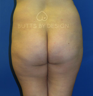 Fat Transfer to the Butt/Brazilian Butt Lift (BBL)